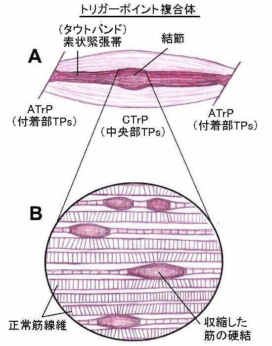 トリガーポイント.jpg