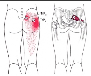 梨状筋トリカ?ーホ?イント.png