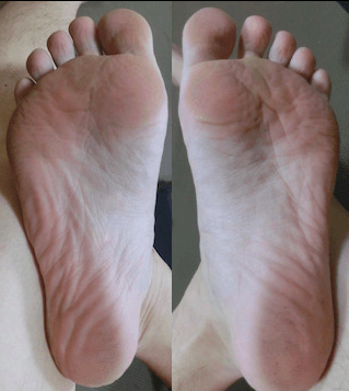 杉本足裏４０キロ走後.png