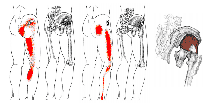 小臀筋のトリガーポイント.png