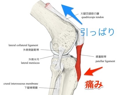 オスク?ットシュラッター病・成長痛.jpg